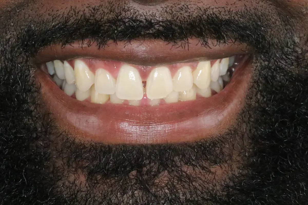 Before — real smile transformation at Lava Dental