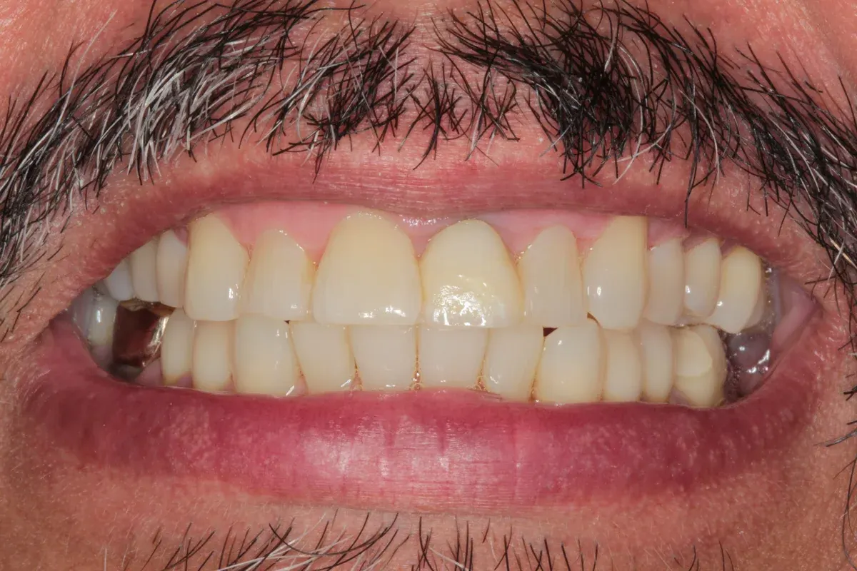 After — real smile transformation at Lava Dental