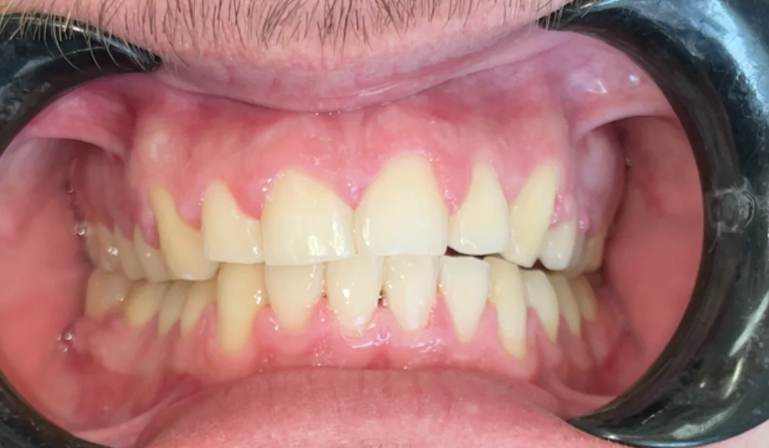 After — real smile transformation at Lava Dental