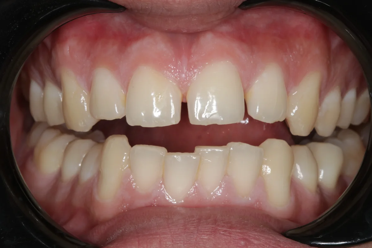 Before — real smile transformation at Lava Dental