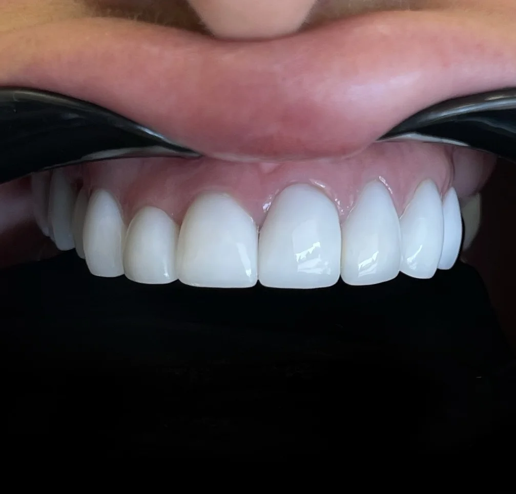 After — real smile transformation at Lava Dental