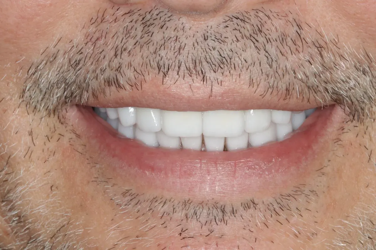 After — real smile transformation at Lava Dental