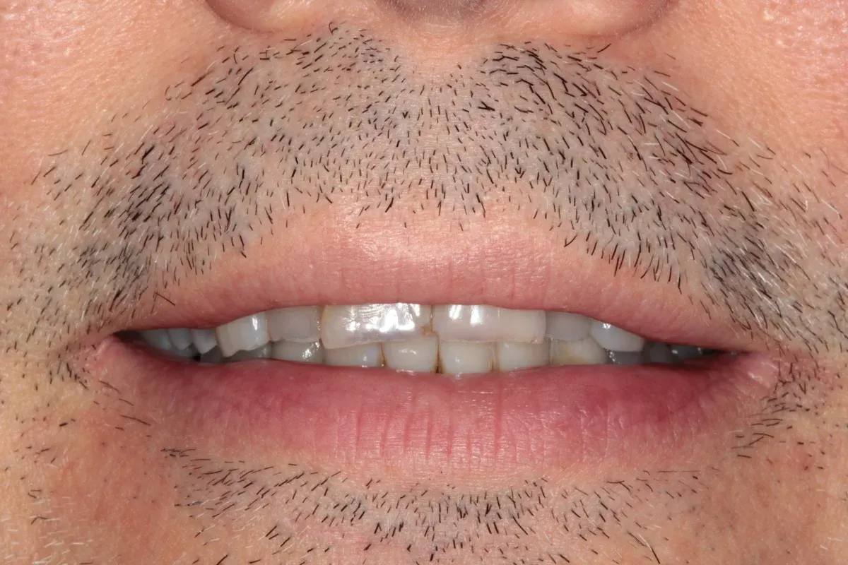 Before — real smile transformation at Lava Dental