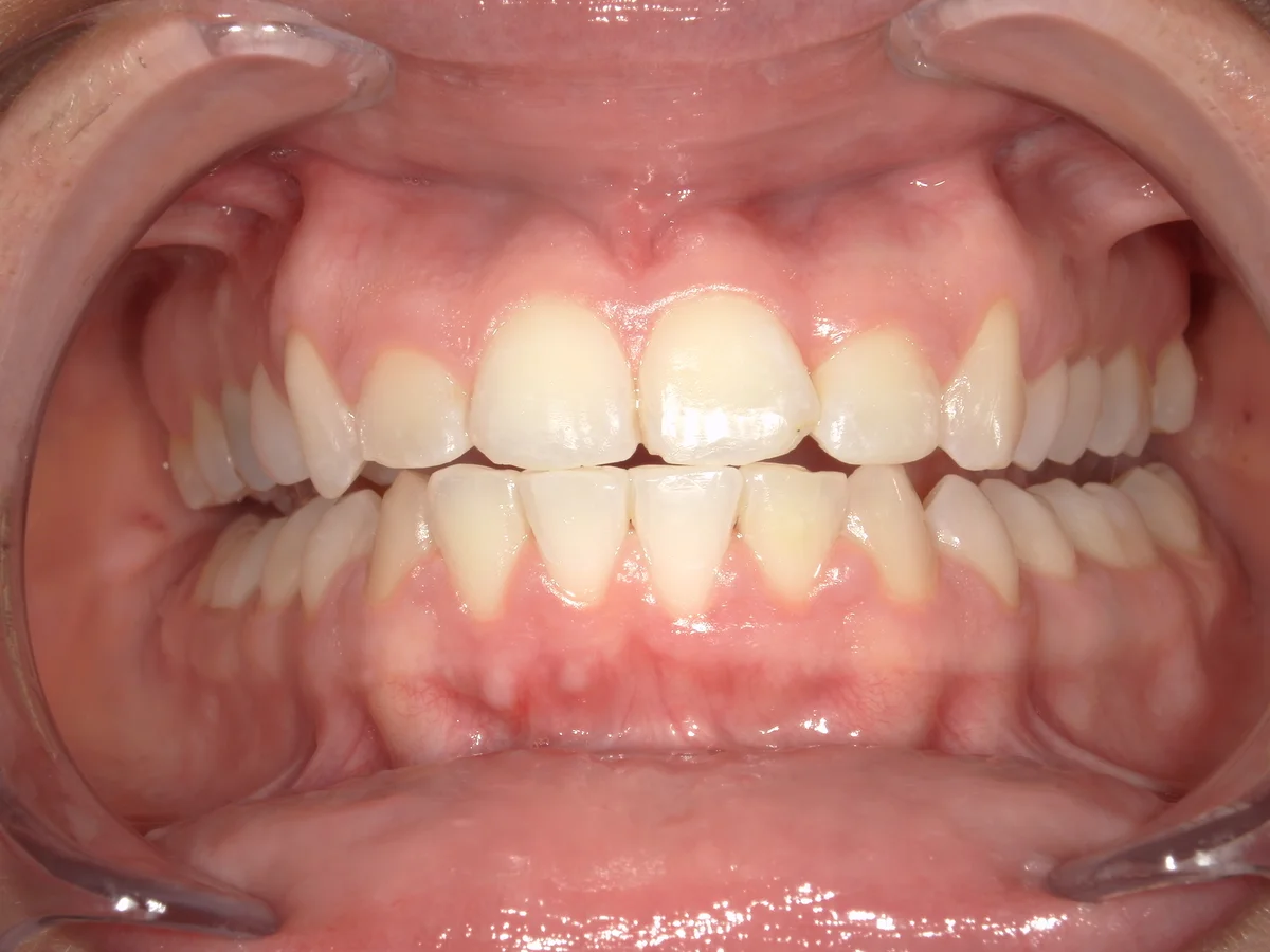 After — real smile transformation at Lava Dental