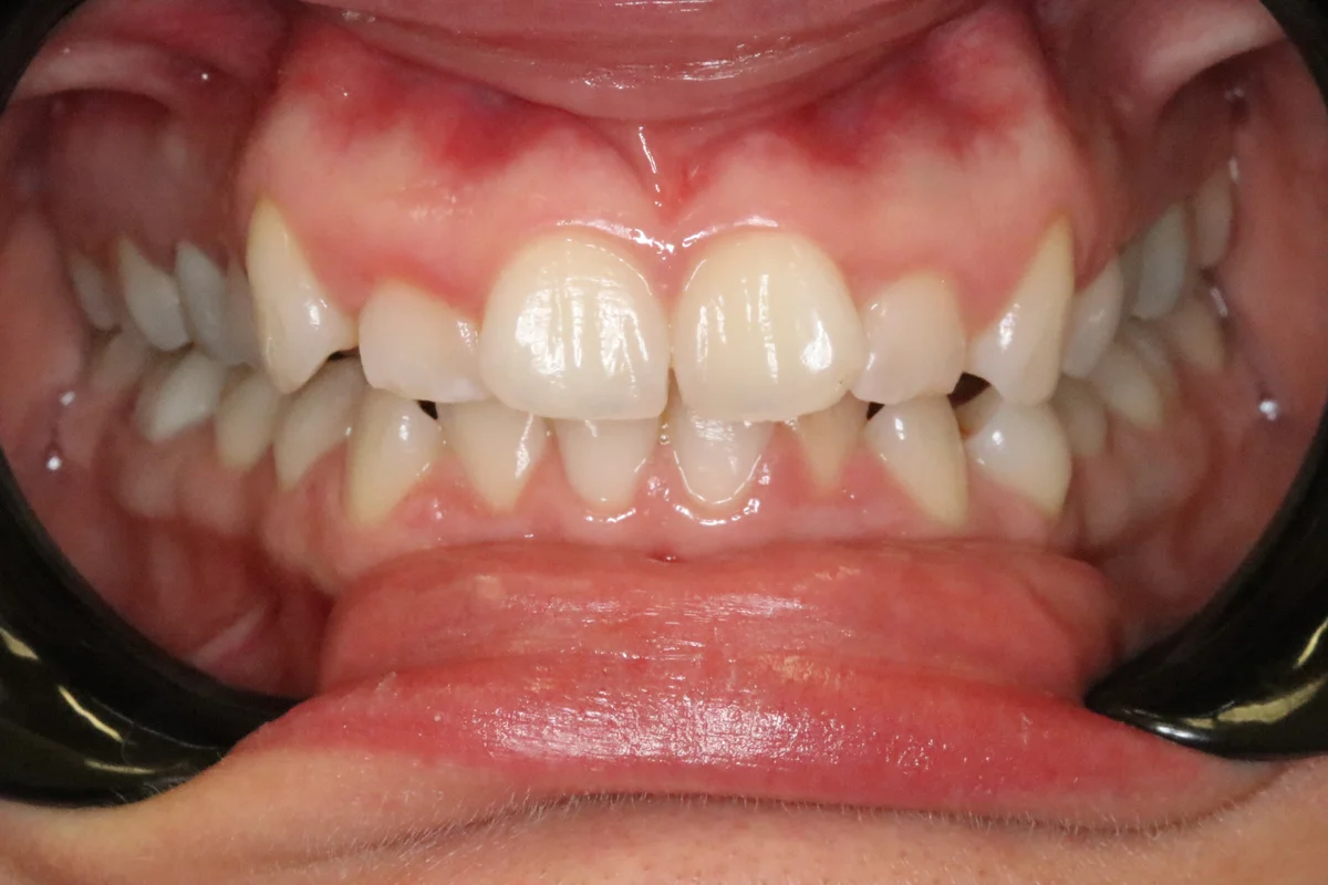 Before — real smile transformation at Lava Dental