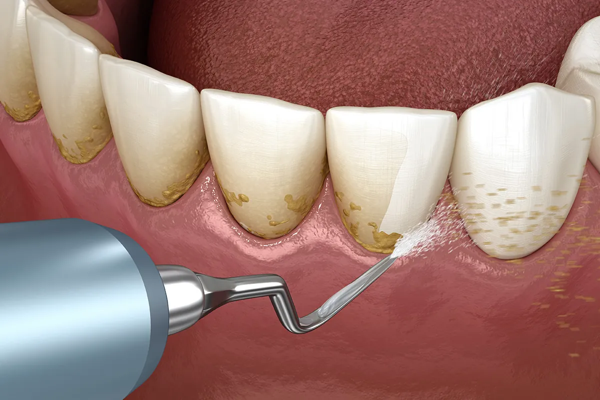 Preventive Dentistry at Lava Dental