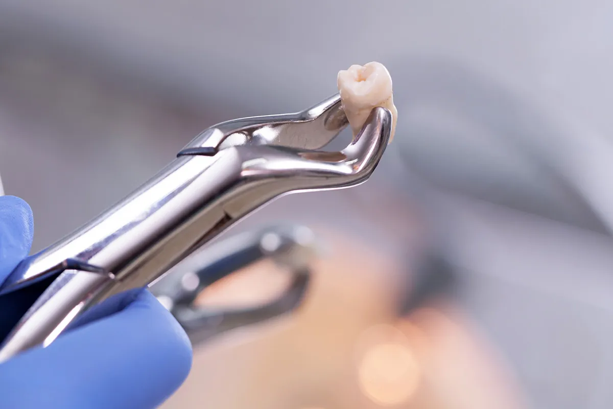 Teeth Extraction at Lava Dental