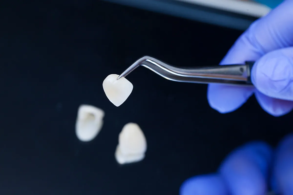 Veneers in Houston, TX