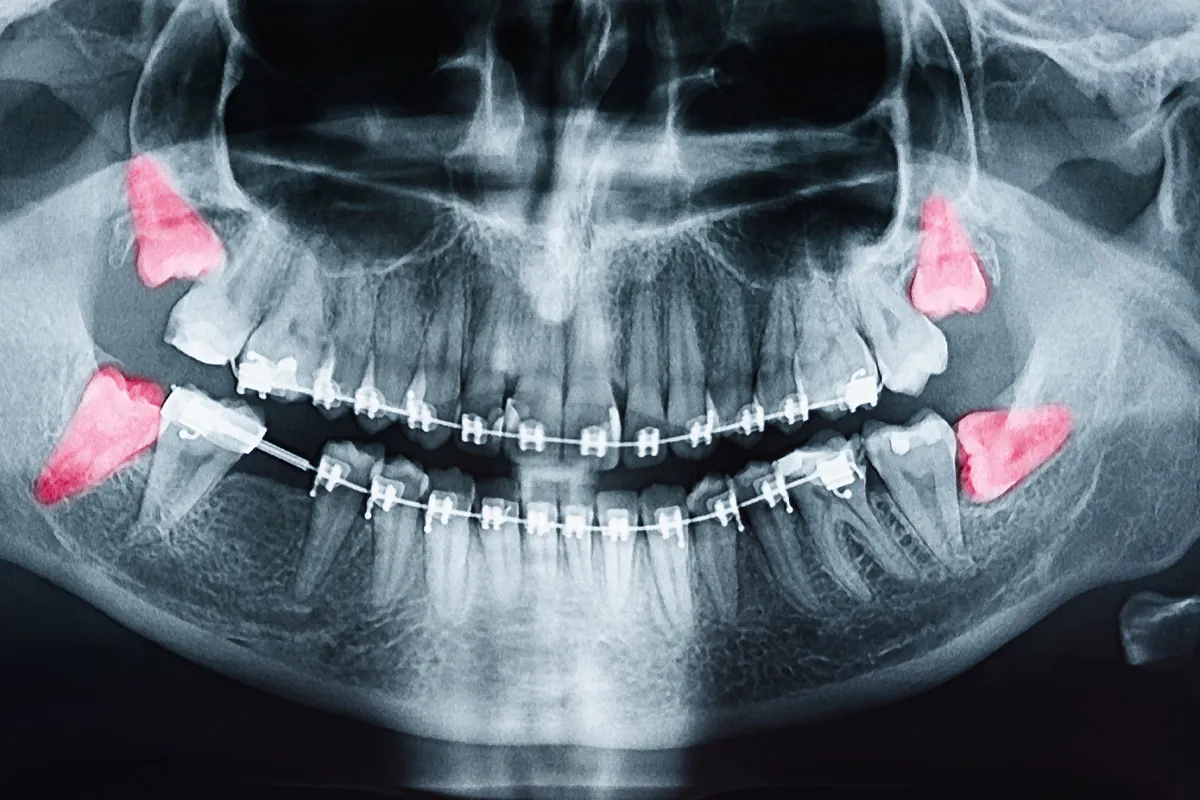 Oral Surgery at Lava Dental
